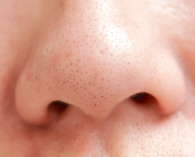 Trị Mụn Đầu Đen Hiệu Quả Tại Sen Beauty